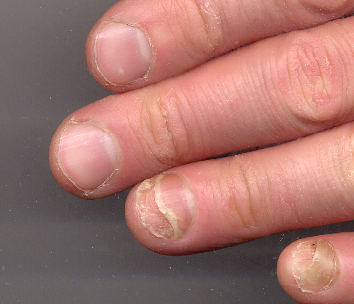 How do you treat fingernail fungus caused by acrylic nails?